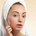 Akne ve Sivilce Problemlerinde Etkili Dermatolojik Yöntemler